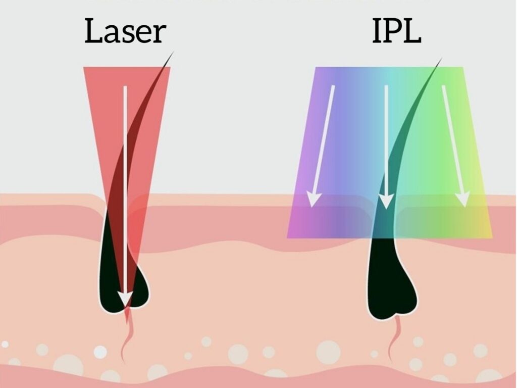 Philips IPL vs Laser Hair Removal Difference